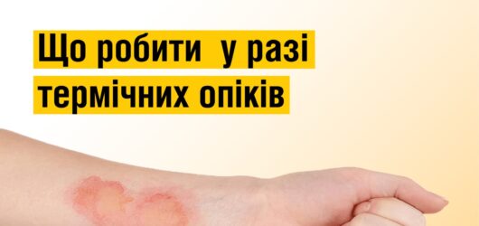 Що робити при опіках?!